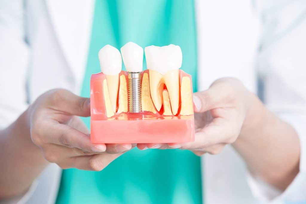 Are Dental Implants Covered By Dental Insurance?