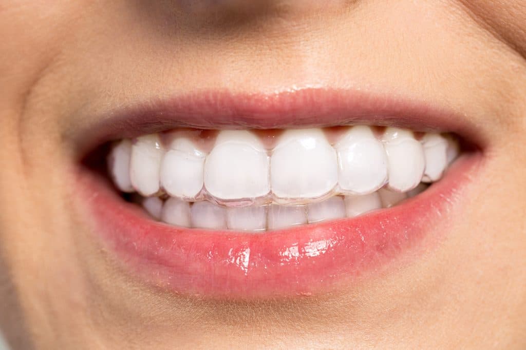 Can Invisalign Fix an Overbite?