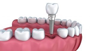 Dental Implant Restoration