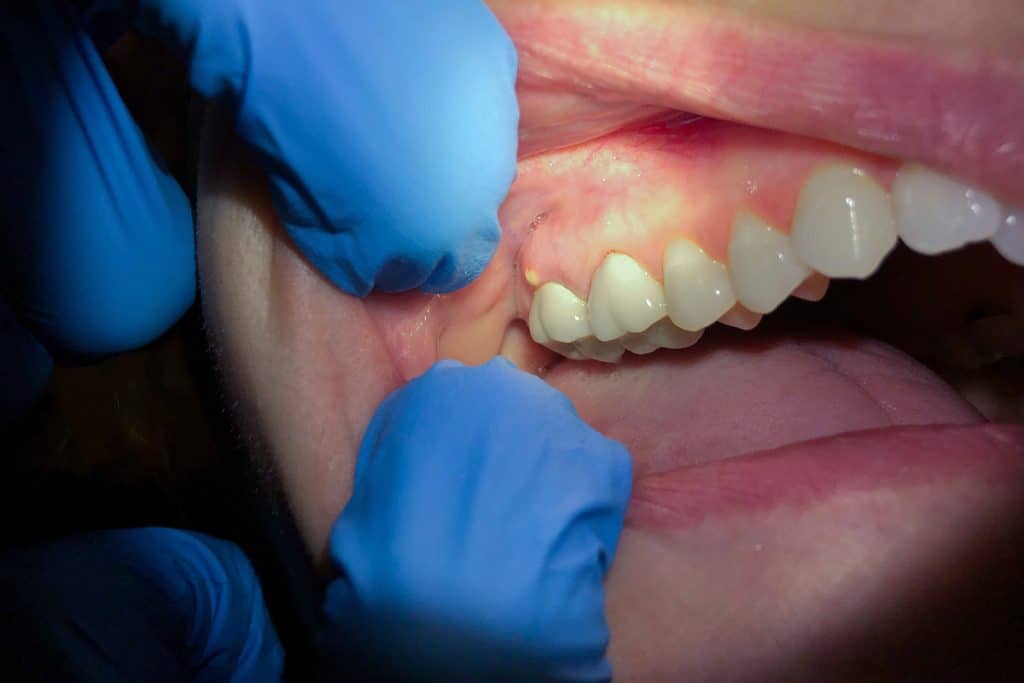 Tooth Abscess Pain at Night? Here’s What To Do Until Morning
